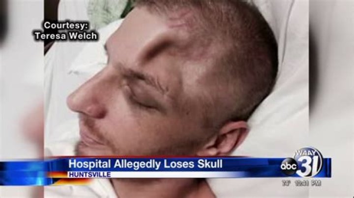 Nashville Man Missing Part of Skull: Shocking Story
